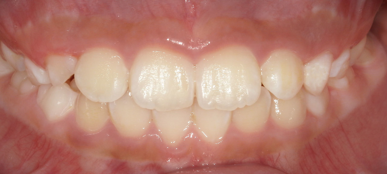 上尾の歯医者で子供の予防矯正の逆咬み矯正後の写真