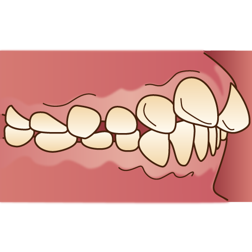 出っ歯と矯正