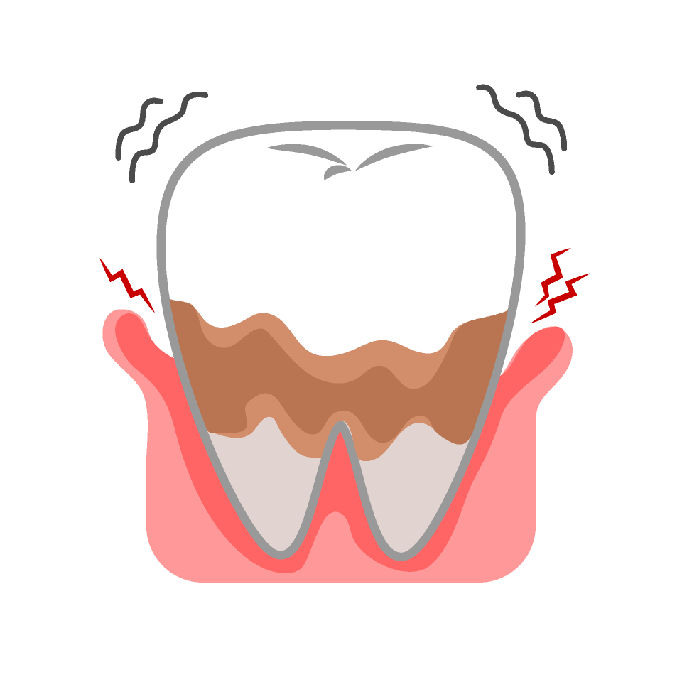 歯周病の原因