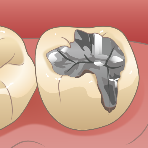 上尾の歯医者で虫歯の原因