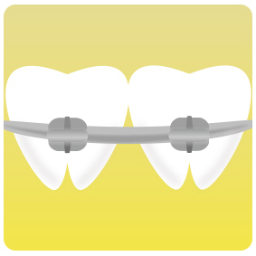 上尾の歯医者矯正歯科でマルチブラケット