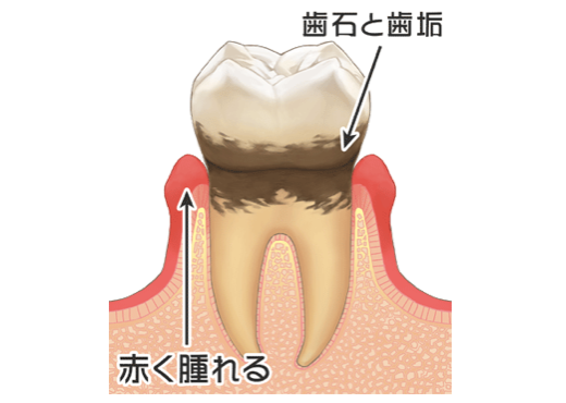 初期の歯周炎