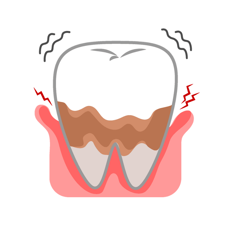 歯のクリーニングによる予防