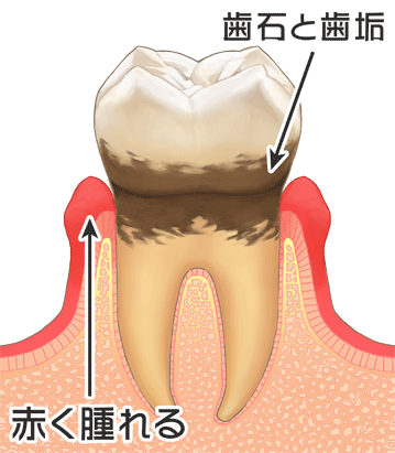 上尾の痛くない歯医者で歯のグラグラする原因