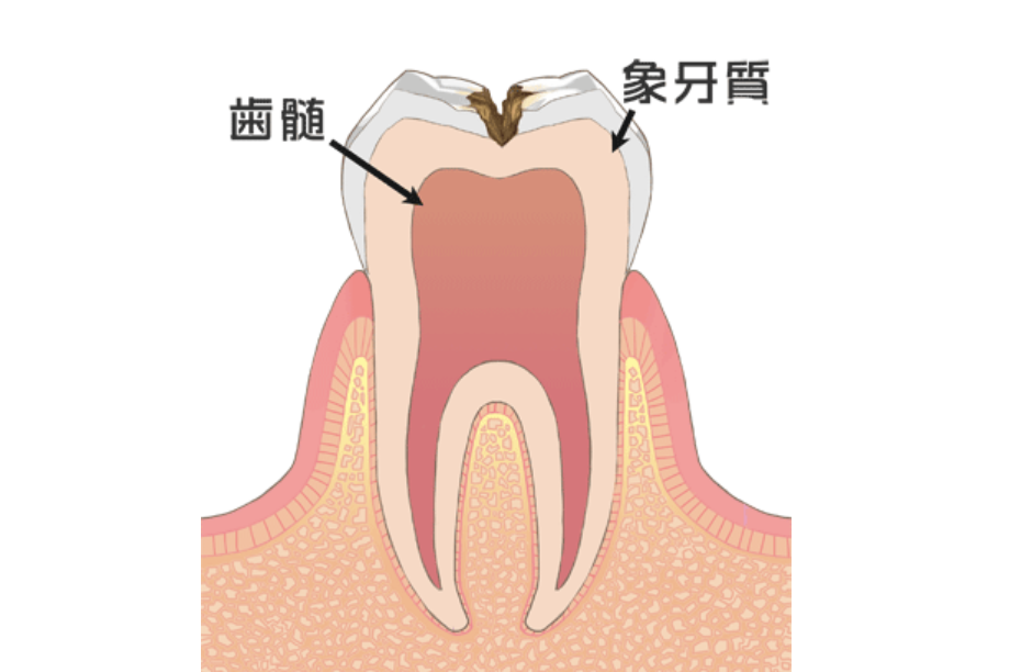 象牙質の虫歯