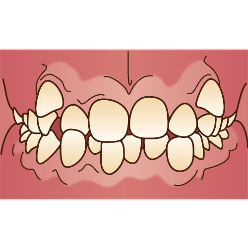 ガタガタ歯並びの周囲からの印象