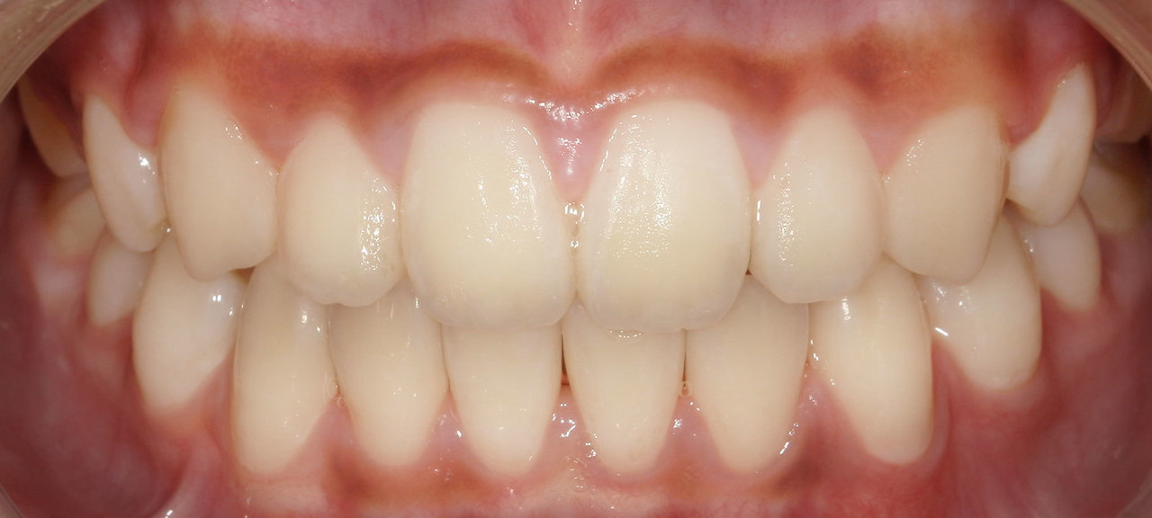上尾の歯医者で子供の予防矯正の矯正後の写真