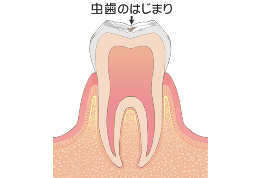 初期の虫歯