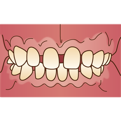 すきっ歯と矯正