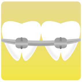 大人の八重歯をマウスピース矯正で治療