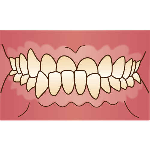 前歯の逆咬みの周囲からの印象