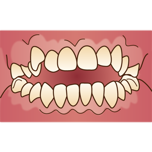 咬んだ時の前歯の隙間と矯正