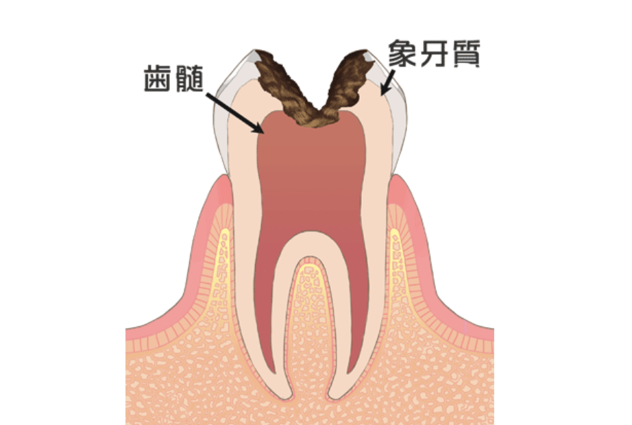 神経まで達している虫歯