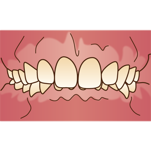 出っ歯の周囲からの印象