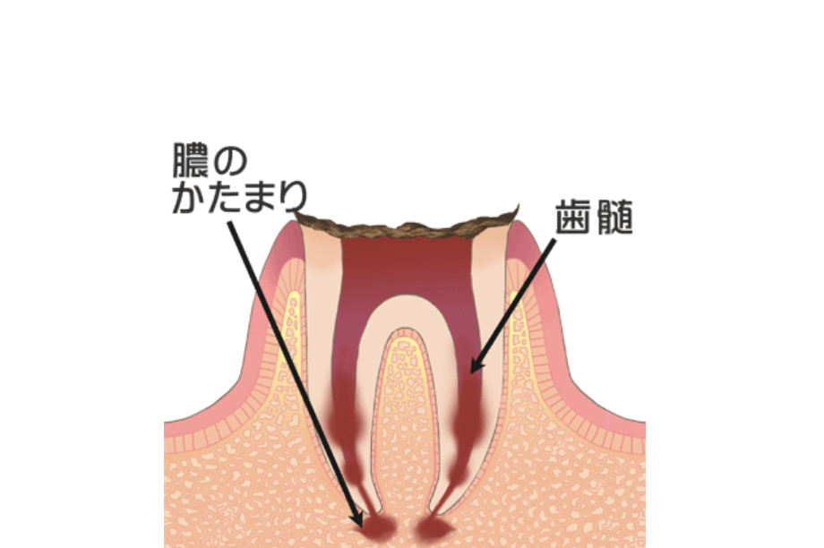 歯根まで達している虫歯