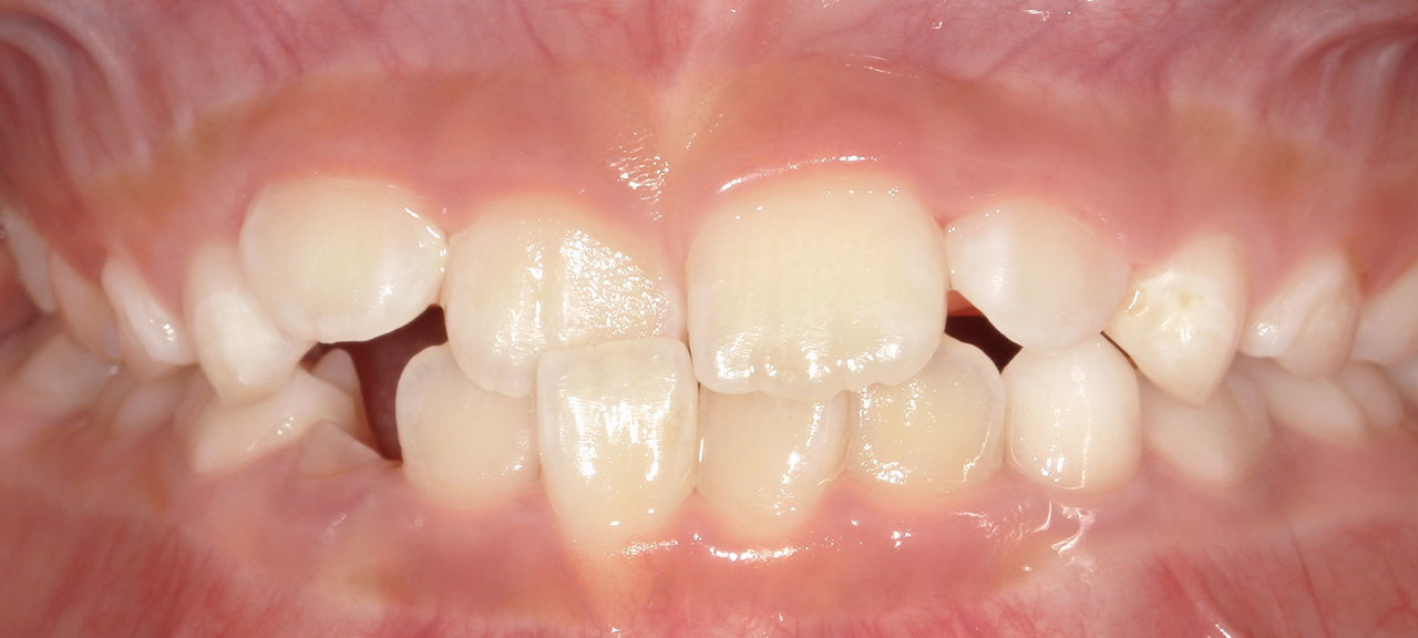 上尾の歯医者で子供の予防矯正の逆咬み矯正前の写真