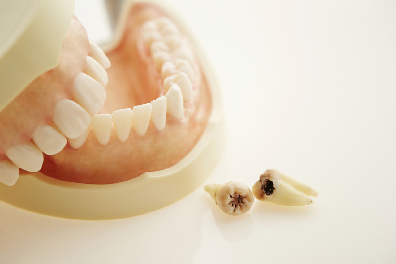 歯周病の感染経路