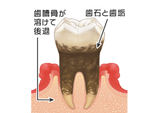 中期の歯周炎
