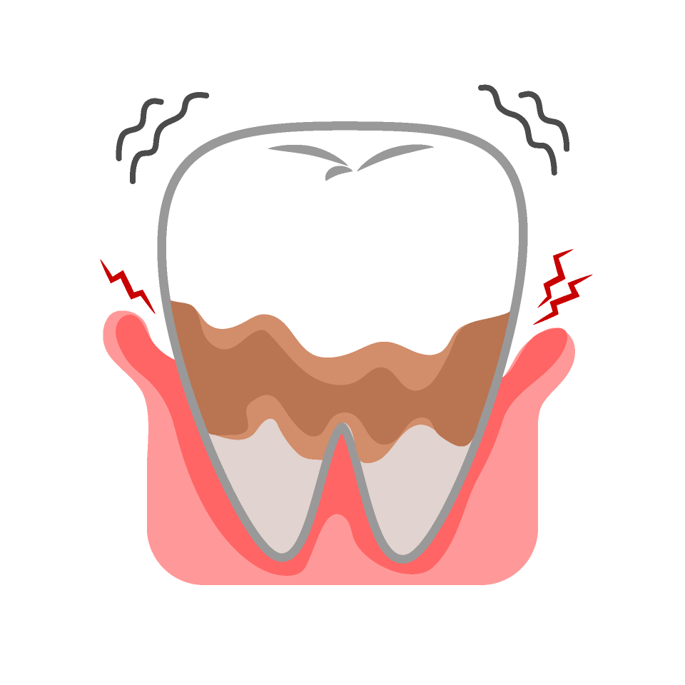 口臭治療の歯周病管理