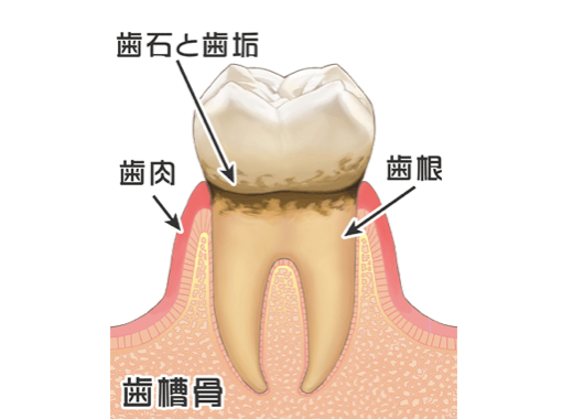 歯肉炎(歯周病になる前の状態)