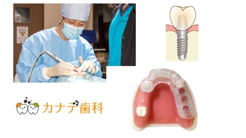 上尾の歯医者で切らないインプラント