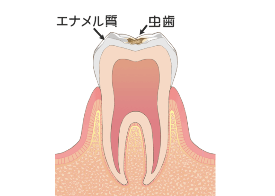 エナメル質の虫歯