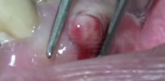 歯ぐきから膿が出る 困ったときの応急処置 注意点 前編 上尾カナデ歯科マウス ピース矯正歯科 公式 虫歯 歯周病